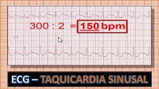 ECG  Eletrocardiograma com Taquicardia Sinusal [upl. by Hinda]