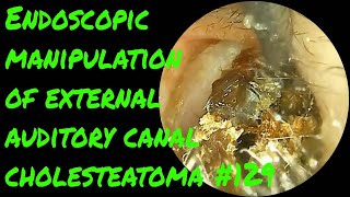 Endoscopic manipulation of external auditory canal cholesteatoma 129 [upl. by Ymereg581]