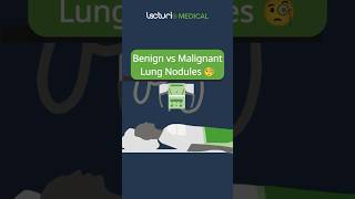 Benign vs Malignant Lung Nodules 🧐 USMLE MedicalEducation Radiology [upl. by Folly]