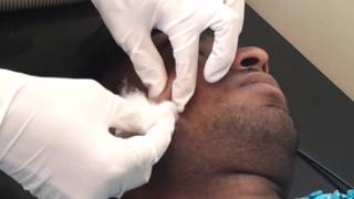 Ellman Radiosurgery Dr Bhutada skin clinic India [upl. by Maiah594]