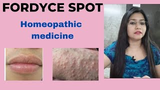 Fordyce Spots White Bumps  Symptoms Causes Treatments  Fordyce spots Homeopathic medicine [upl. by Klinger]