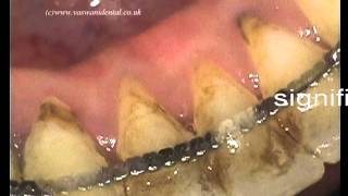 Non Surgical Periodontal Treatment [upl. by Donata84]