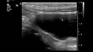 Intussusception US and Reductionmp4 [upl. by Fridlund216]