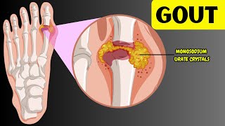 Understanding Gout  Causes Risk Factors Signs amp Symptoms Diagnosis amp Treatment [upl. by Aissenav]