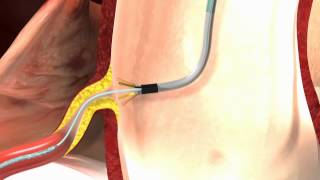 Ostial PRO® Stent Positioning System 3D Animated Video [upl. by Ayerdna438]