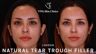 Tear Trough Filler London  VIVA Skin Clinics [upl. by Myranda]