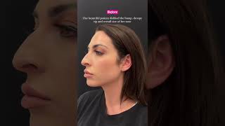 Leila Hormozi 1 week after Designer Rhinoplasty® [upl. by Rogerio]