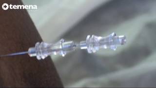 Spinal Anaesthesia with MicroTip® needle Part 22 [upl. by Alfonso926]