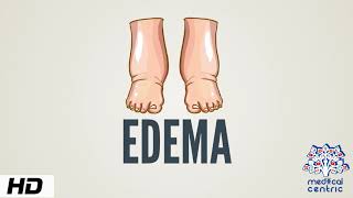 Edema Causes Signs and Symptoms Diagnosis and Treatment [upl. by Acinad]