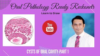 Cysts of Orofacial Region Part 1 Mucocele Botryoid cyst calcifying cyst aneurysmal cyst [upl. by Coveney]