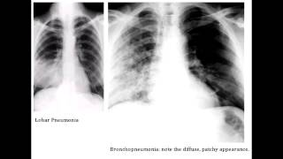 Lobar Pneumonia amp Bronchopneumonia  Organisms amp Characteristics [upl. by Ardnuassak463]