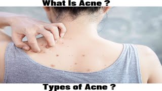 What Is Acne Types Of Acne [upl. by Sigfried816]