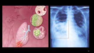 Atypical Pneumonia [upl. by Lenes]