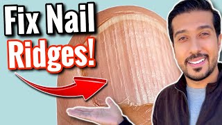 Vertical Ridges on Nails  What Are Your NAILS Trying to Say [upl. by Haywood]