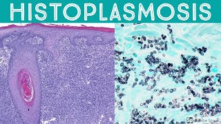 Histoplasmosis Two Extreme Examples Pseudotumor amp Zero Inflammation [upl. by Jezabella]