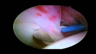 Labral Tear  Detached Anterior Labrum [upl. by Sprage208]