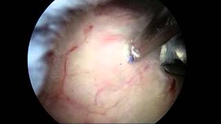 Arthroscopic removal of calcium deposit from shoulder calcific tendonitis [upl. by Ced]