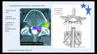 3 Key Ligaments of the Lumbar Spine and Their Related Pathology Disc Herniation Stenosis amp DISH [upl. by Kcirdek]