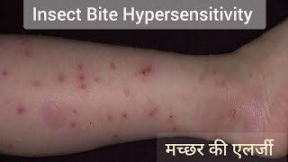 मच्छर की एलर्जी  Insect Bite Hypersensitivity  Papular Urticaria Mosquito Bite Reaction mosquito [upl. by Lorna]