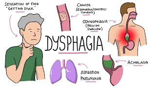 Dysphagia  Oropharyngeal amp Esophageal Dysphagia CausesDifferential Diagnosis Signs Treatment [upl. by Azilef]