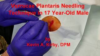 Verrucae Plantaris Needling Procedure Technique [upl. by Eilis121]