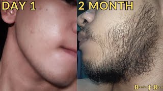 Minoxidil Beard Journey 2 MONTH TRANSFORMATION [upl. by Eiroc]