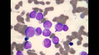 Acute Myeloblastic Leukemia M1 [upl. by Goulet684]