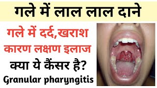 गले में खराश गले में लाल दाने Granular pharyngitis कारण लक्षण इलाज  Symptoms Causes Treatment [upl. by Sakhuja201]