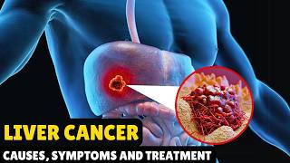 Liver Cancer – Causes Signs and Symptoms Diagnosis amp Treatment [upl. by Adnulahs228]