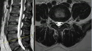 RM Anatomia da Coluna Lombar [upl. by Ashly]