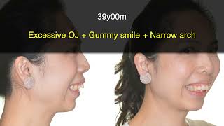 Excessive Overjet and Gummy Smile Treated with Clear Aligners｜【Chris Chang Ortho】CC671 [upl. by Kalagher]