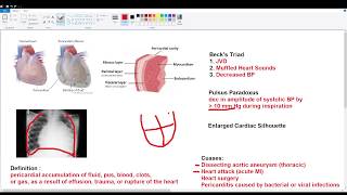 Cardiac Tamponade [upl. by Ramhaj]