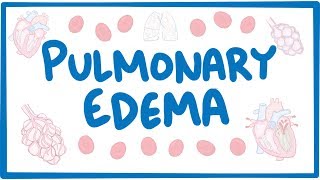 Pulmonary Edema  causes symptoms diagnosis treatment pathology [upl. by Xymenes]