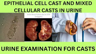 EPITHELIAL CELL CAST AND MIXED CELL CAST IN THE URINE CAUSES SYMPTOMS AND TREATMENT [upl. by Eddie]