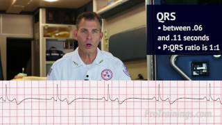 Bradycardia ECG Rhythm Interpretation [upl. by Yboc18]