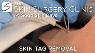 Skin Tag Removal  Watch the Procedure [upl. by Grove]