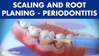 Treatment of periodontal disease  Scaling and root planing  Tartar © [upl. by Abdul]