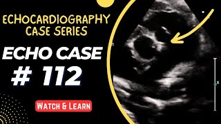 Echocardiography Case 112  Echocardiography For Beginners [upl. by Nellak392]