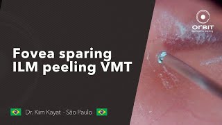 Orbit Tips 022 Fovea sparing ILM peeling VMT [upl. by Hippel317]