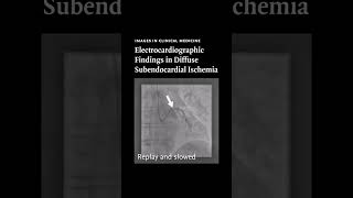 Images in Clinical Medicine Electrocardiographic Findings in Diffuse Subendocardial Ischemia [upl. by Ayhtak]