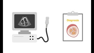 Assessing endocarditis with echocardiography [upl. by Suivatram]