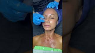 Aquagold Microneedling Up Close At Beverly Hills Wellness Center amp Med Spa Florida shorts [upl. by Marva248]