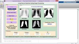 Lung Cancer Detection Using Image Processing Full Matlab Project Code IEEE Based Project [upl. by Emmerich]