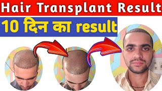 10 Days Hair transplant results hair transplant 10 days review hair transplant [upl. by Ahseinar]