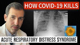 How Coronavirus Kills Acute Respiratory Distress Syndrome ARDS amp COVID 19 Treatment [upl. by Selij]