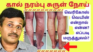 கால் நரம்பு சுருள் நோய்  varicose veins symptoms treatment [upl. by Brandie412]