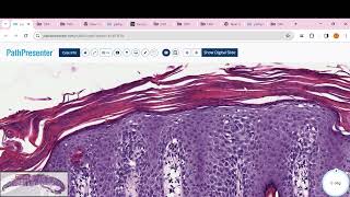 PITYRIASIS ROSEA Psoriasis clear cell acanthoma Lichen planus BLK LICHEN SCLEROSUS [upl. by Okram]