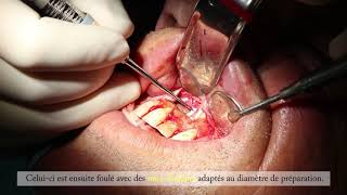 La Chirurgie Endodontique  Dr Matthieu Marret [upl. by Yllitnahc278]