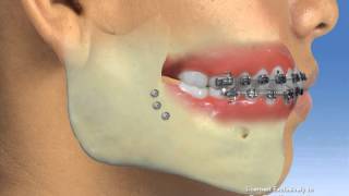 Orthodontics  Surgery [upl. by Taveda]