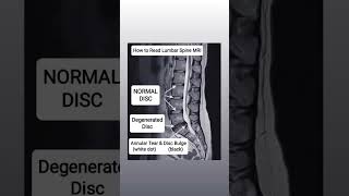 How to Read Lumbar Spine MRI viral mri shorts [upl. by Cadmarr916]